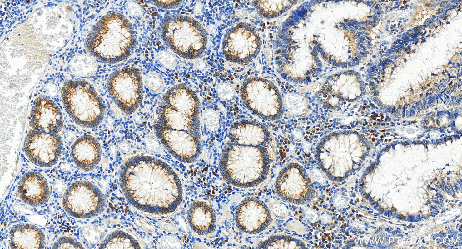 IHC staining of human colon cancer using 26712-1-AP