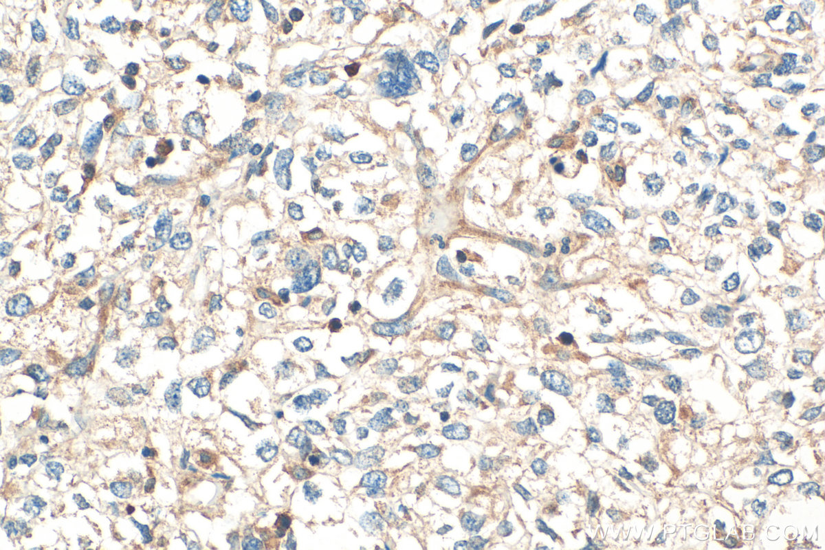 IHC staining of human pancreas cancer using 14955-1-AP IHC staining of human pancreas cancer using 14955-1-AP