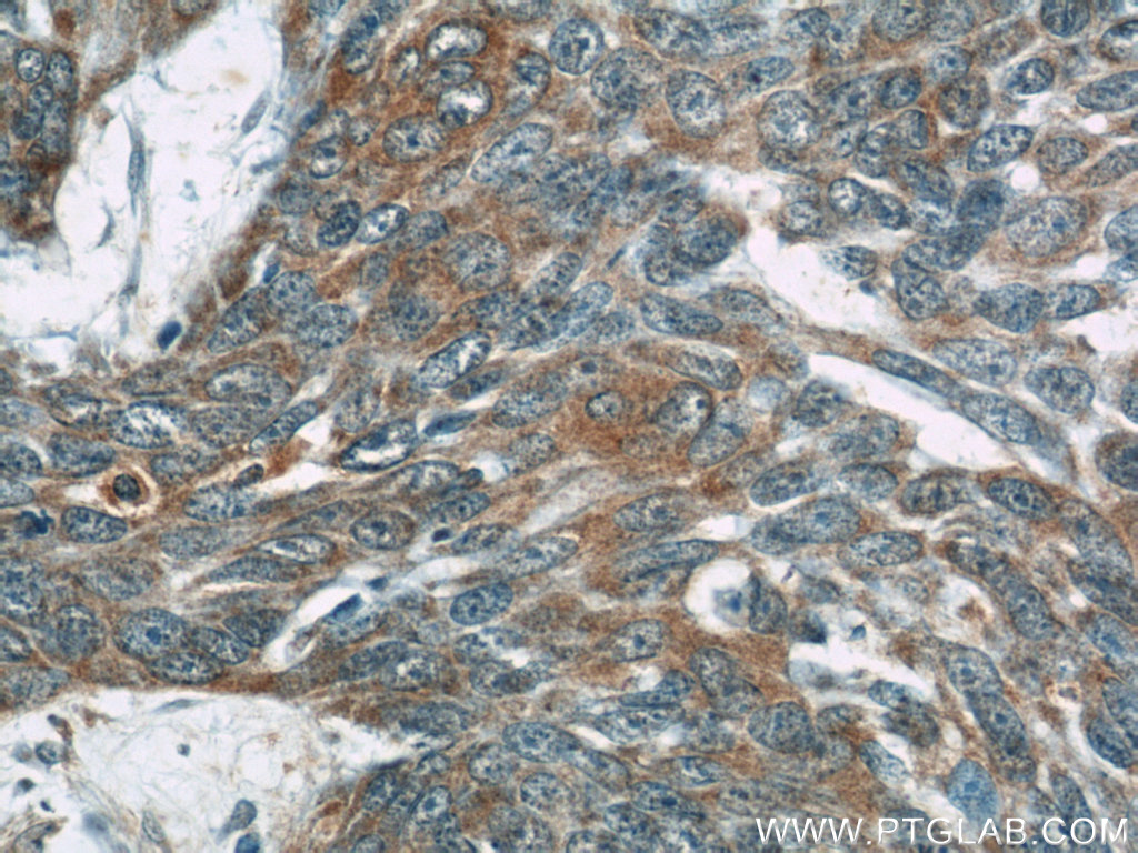 IHC staining of human skin cancer using 21915-1-AP