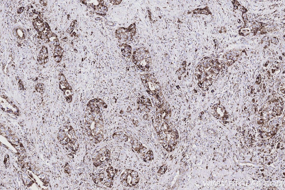 IHC staining of human pancreas cancer using 85218-2-RR IHC staining of human pancreas cancer using 85218-2-RR