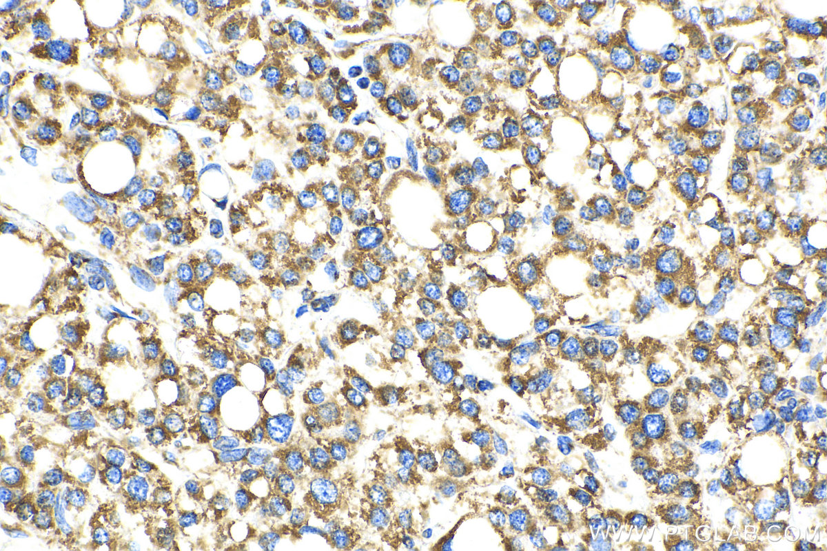 IHC staining of human liver cancer using 66698-1-Ig