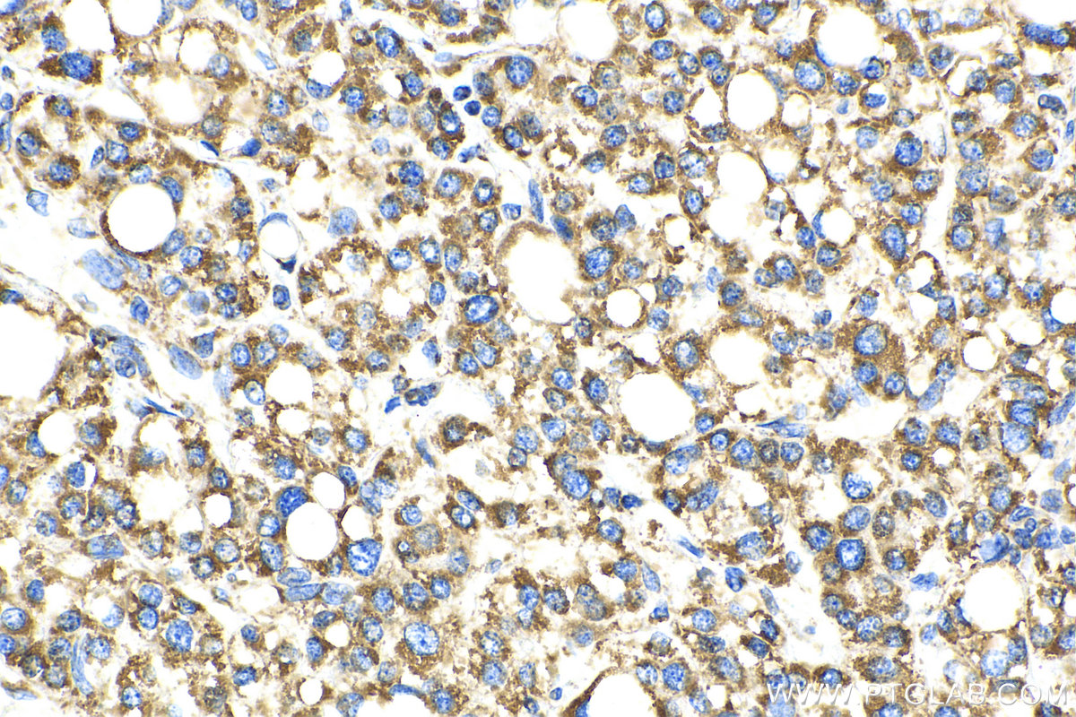 IHC staining of human liver cancer using 66698-1-Ig