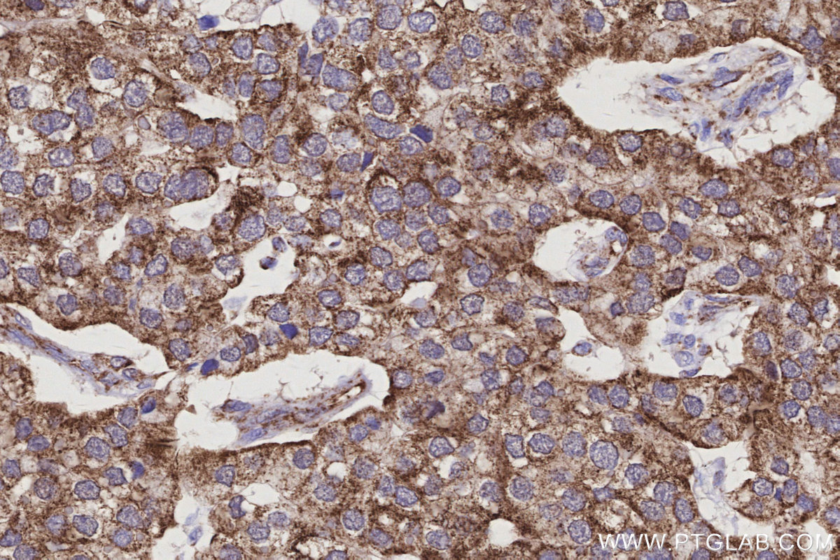 IHC staining of human stomach cancer using 66698-1-Ig
