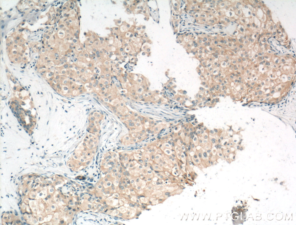 IHC staining of human breast cancer using 13409-1-AP (same clone as 13409-1-PBS)