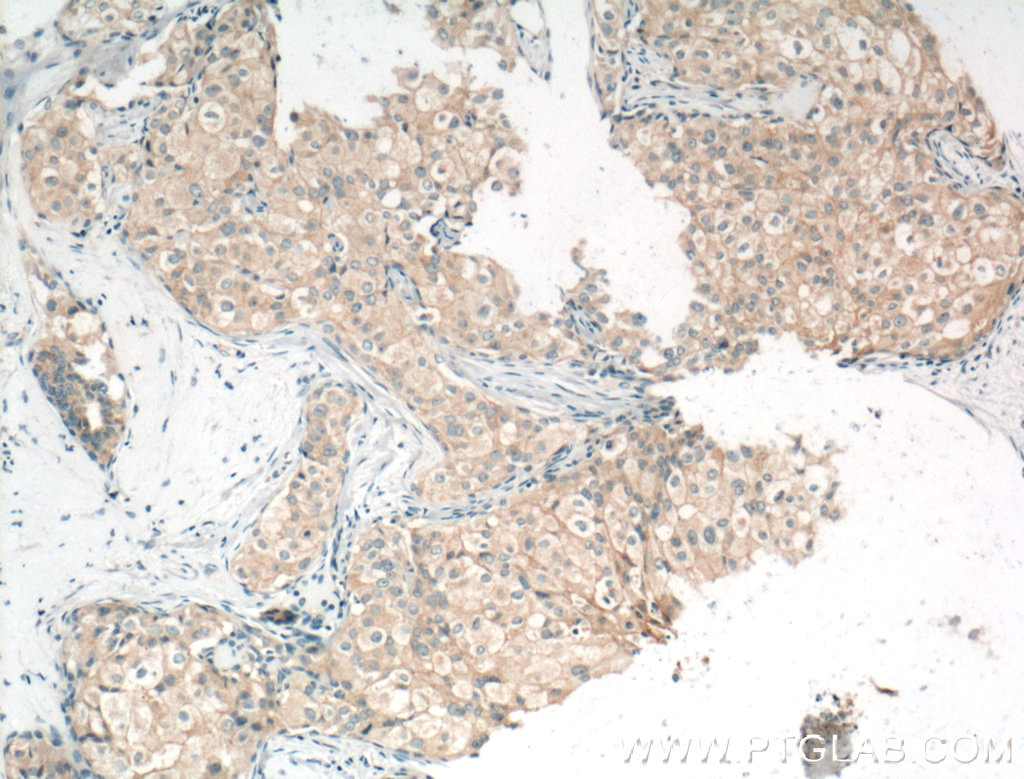 IHC staining of human breast cancer using 13409-1-AP