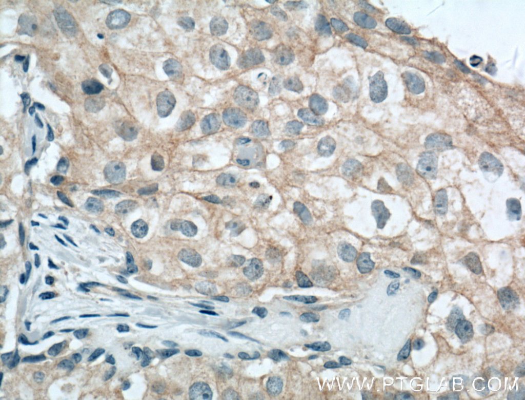 IHC staining of human breast cancer using 13409-1-AP