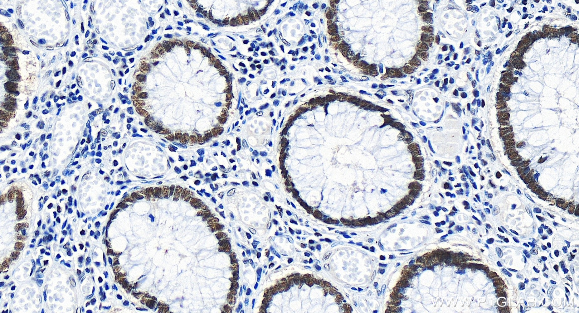 IHC staining of human colon cancer using 85726-1-RR