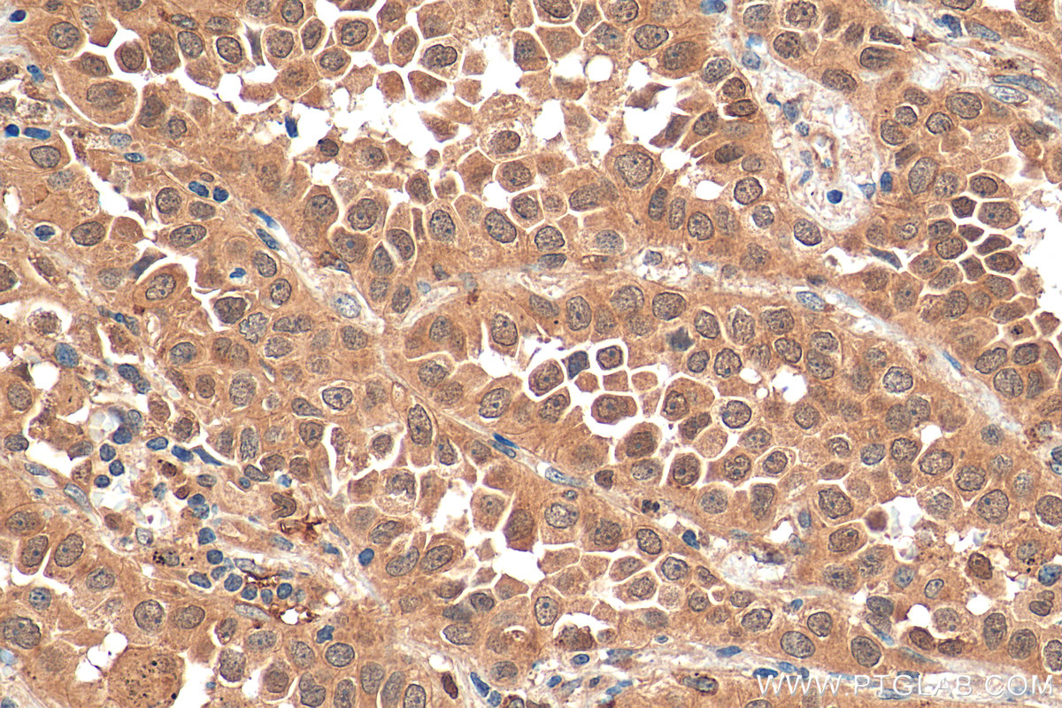 IHC staining of human lung cancer using 11263-1-AP