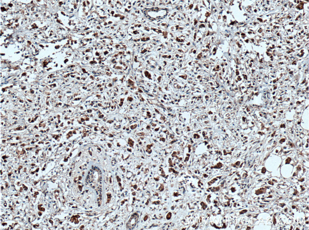 IHC staining of human breast cancer using 60242-1-Ig (same clone as 60242-1-PBS)