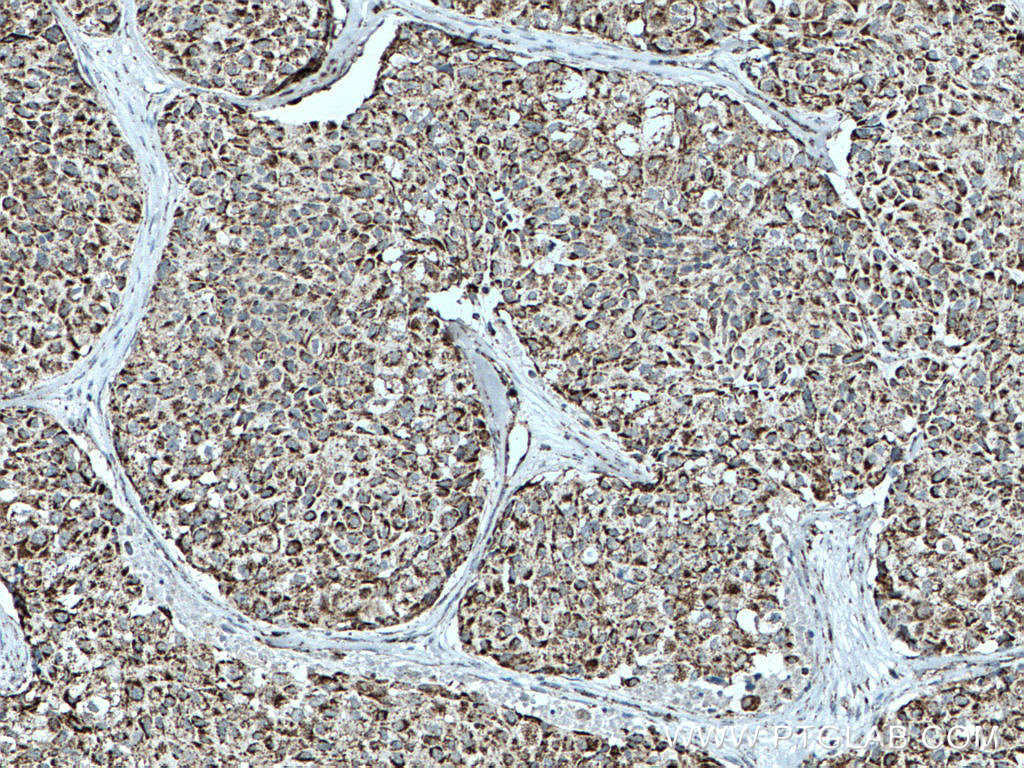 IHC staining of human lung cancer using 15212-1-AP