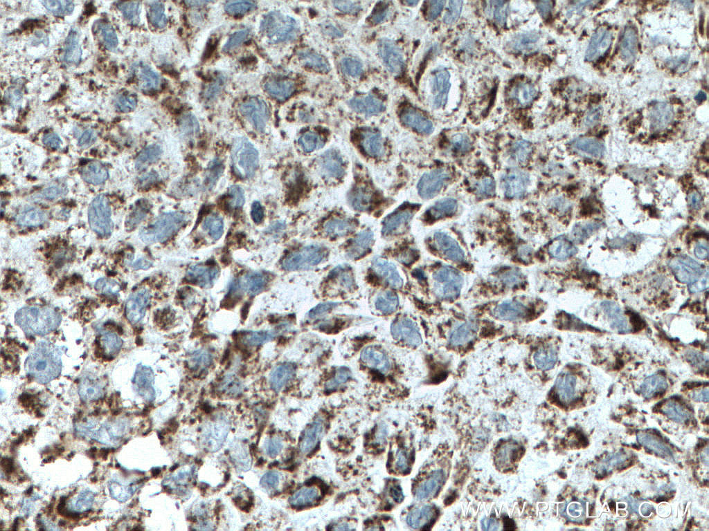 IHC staining of human lung cancer using 15212-1-AP