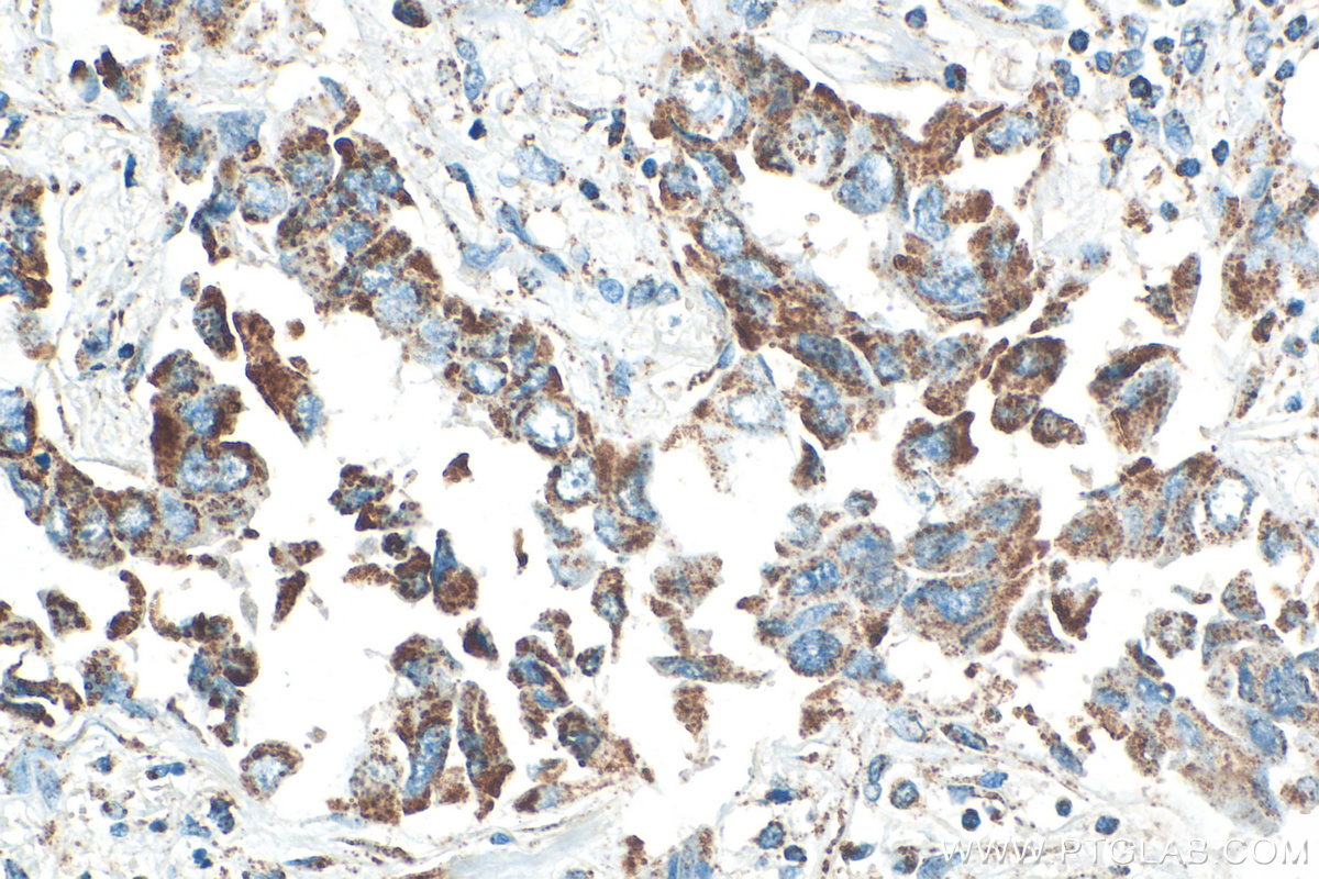 IHC staining of human lung cancer using 15212-1-AP IHC staining of human lung cancer using 15212-1-AP