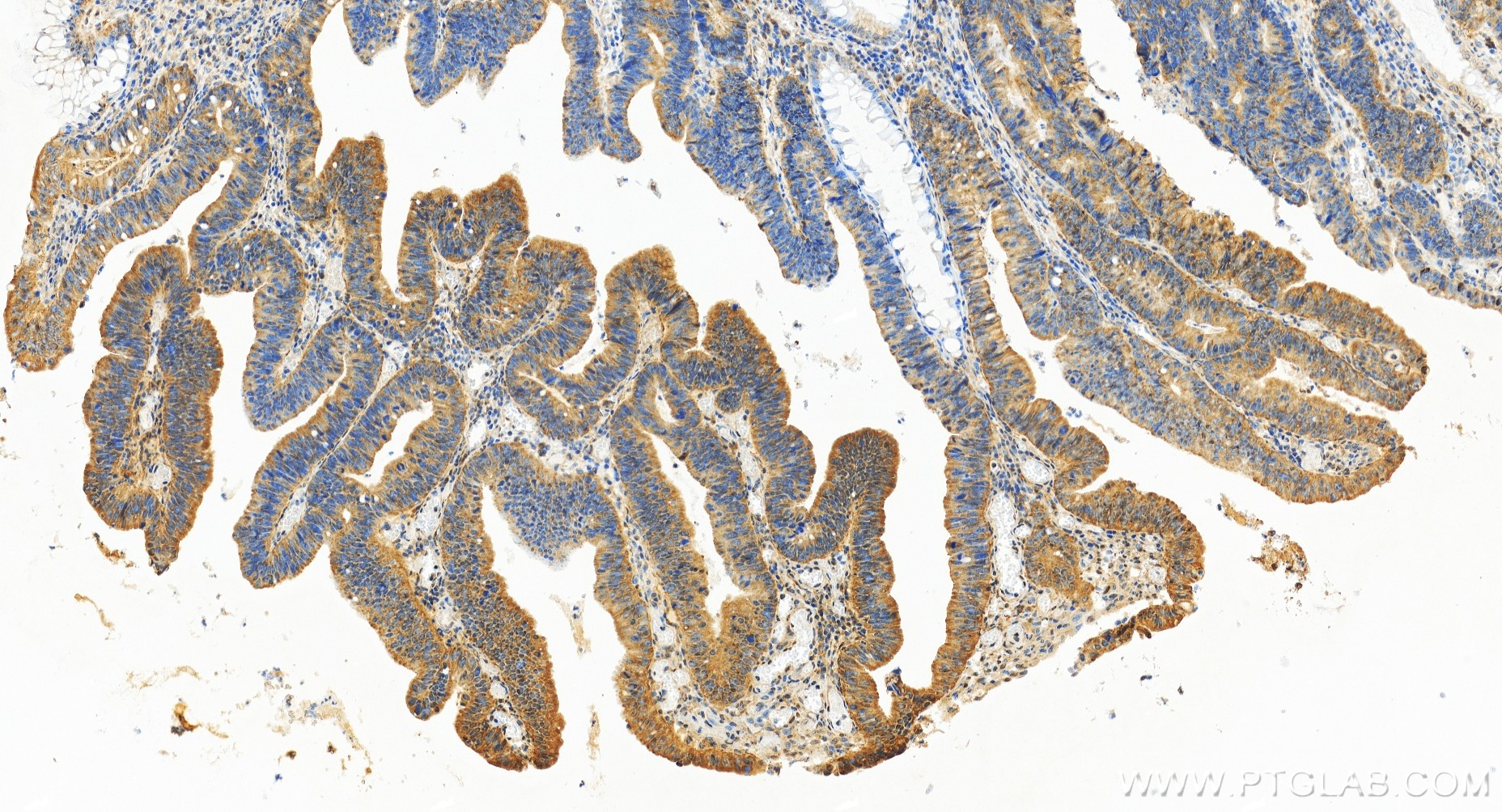 Immunohistochemical analysis of paraffin-embedded human colon cancer tissue slide using 85998-1-RR (OGFR antibody) at dilution of 1:500 (under 10x lens). Heat mediated antigen retrieval with Tris-EDTA buffer (pH 9.0). IHC staining of human colon cancer using 85998-1-RR