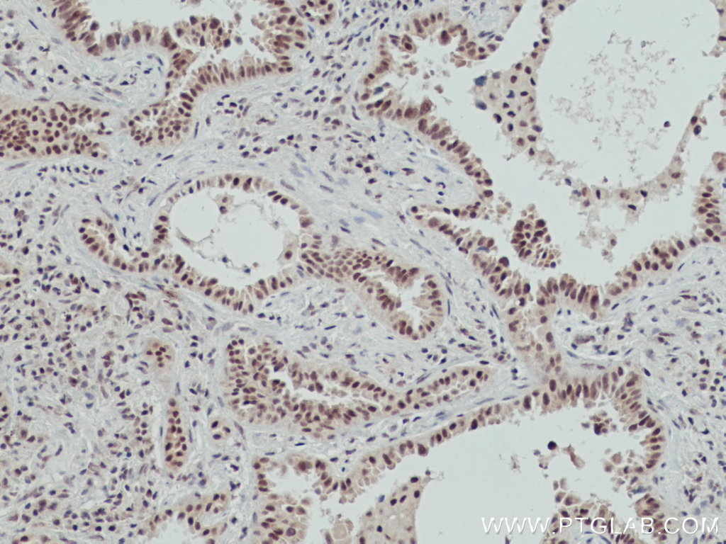 IHC staining of human lung cancer using 66823-1-Ig