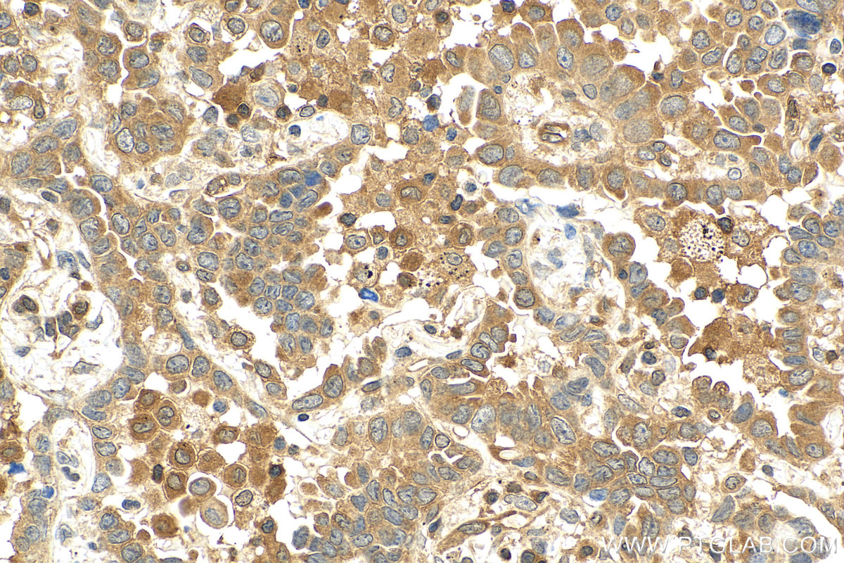 IHC staining of human lung cancer using 51002-1-AP