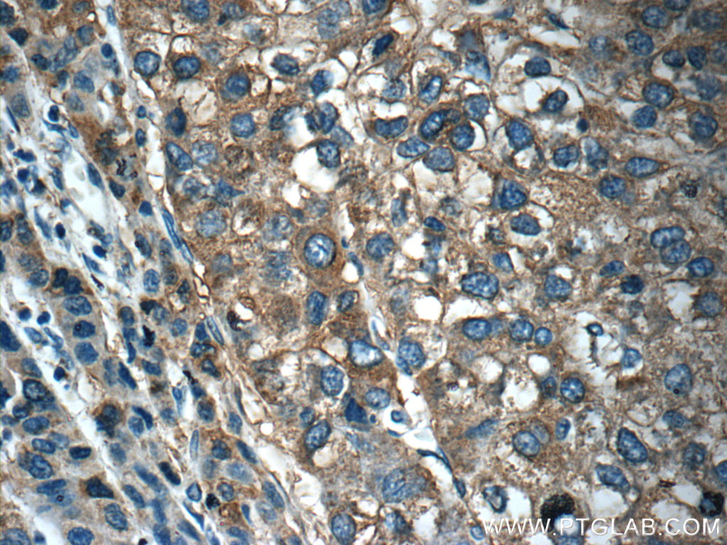 IHC staining of human liver cancer using 12596-1-AP