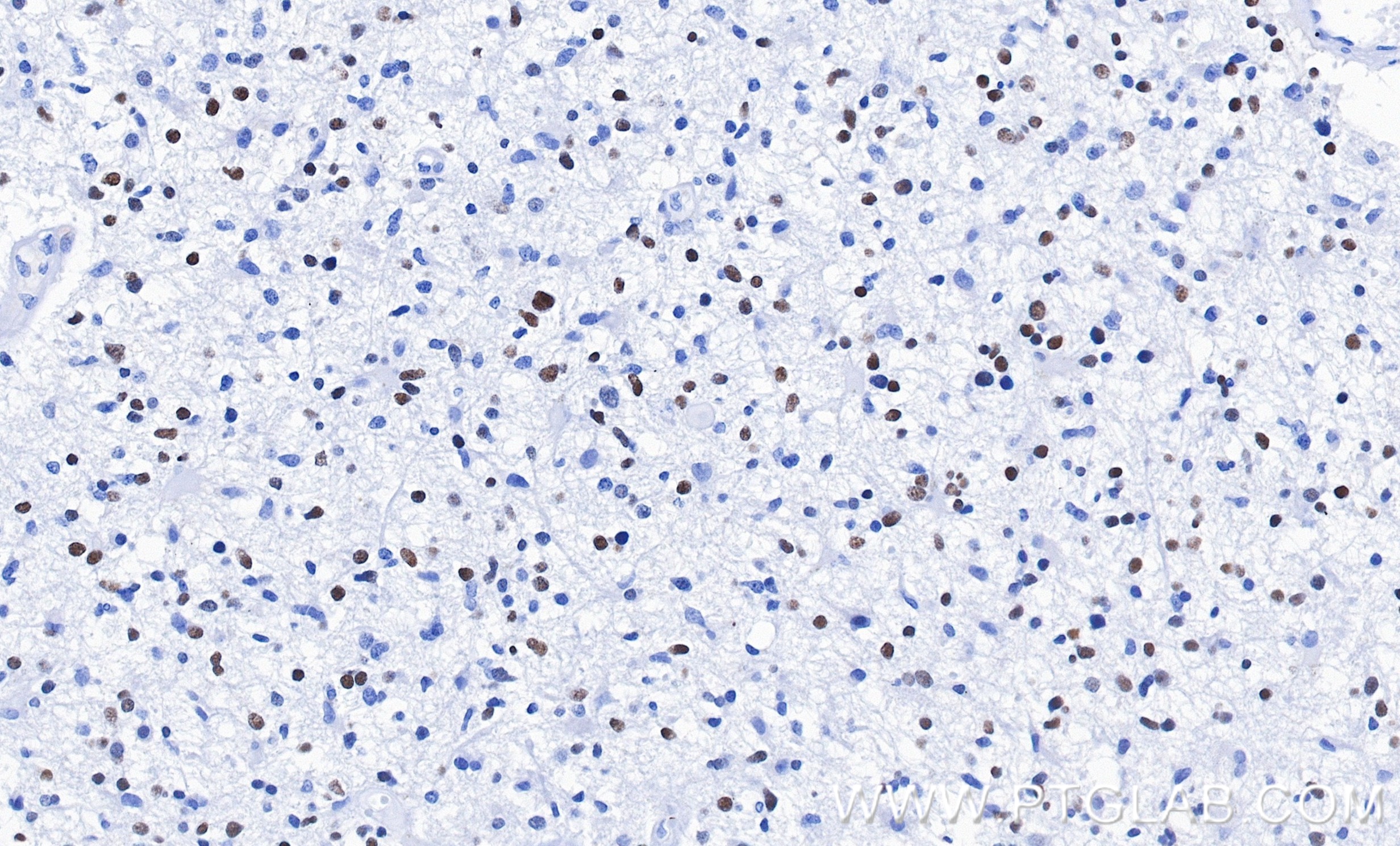 IHC staining of Human brain cancer(Astrocitoma) using 82806-7-RR IHC staining of Human brain cancer(Astrocitoma) using 82806-7-RR
