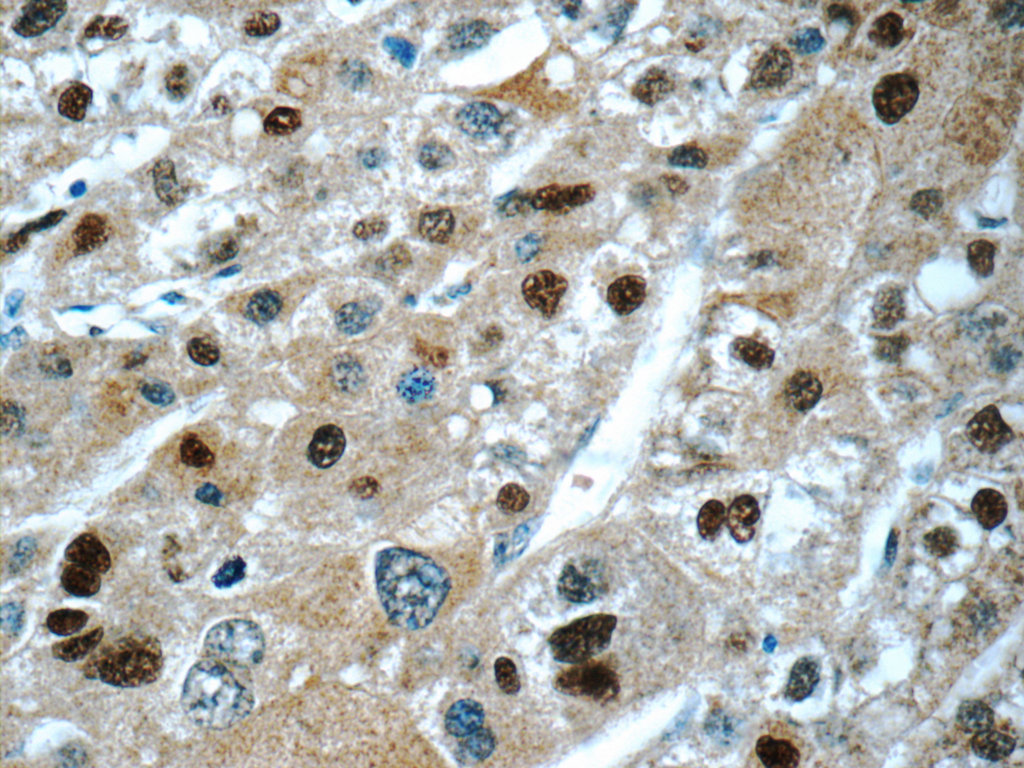 IHC staining of human liver cancer using 25137-1-AP (same clone as 25137-1-PBS)
