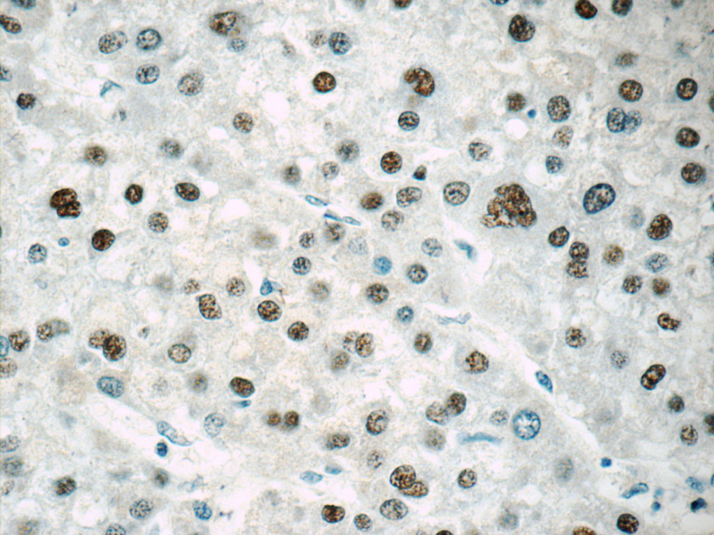 IHC staining of human liver cancer using 25137-1-AP (same clone as 25137-1-PBS)