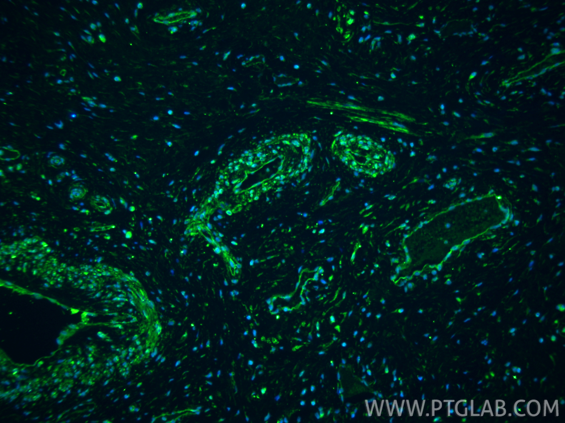 IF Staining of human cervical cancer using 22952-1-AP IF Staining of human cervical cancer using 22952-1-AP