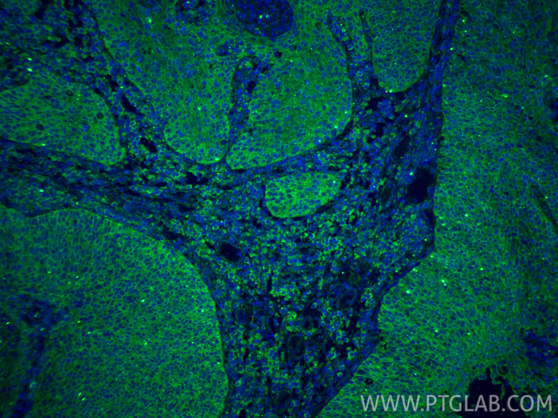 IF Staining of human cervical cancer using 22952-1-AP IF Staining of human cervical cancer using 22952-1-AP