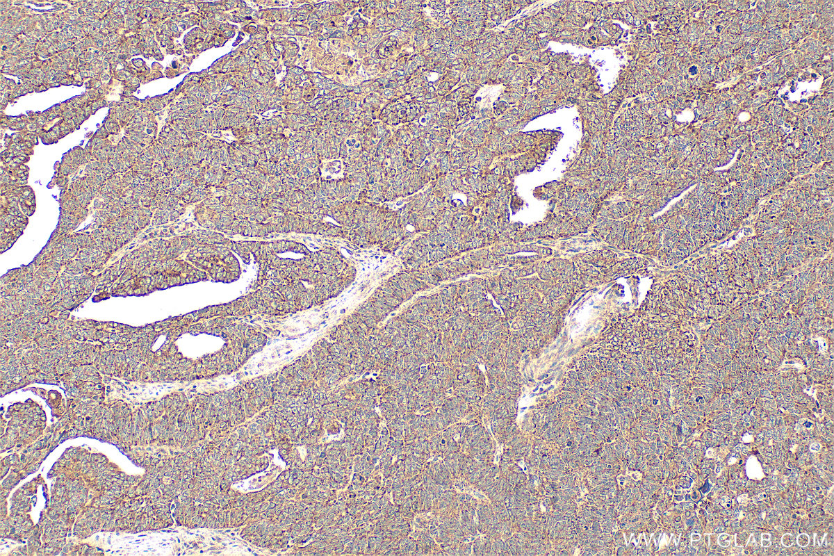 IHC staining of human ovary tumor using 22952-1-AP