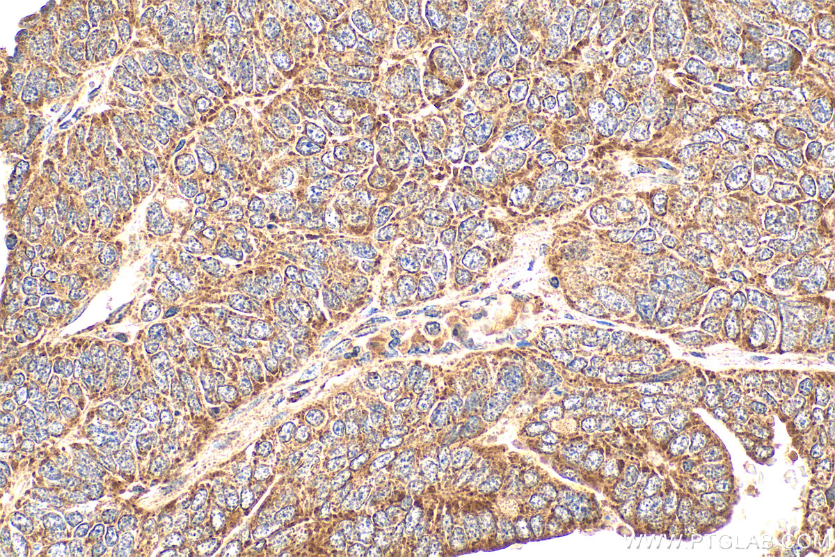IHC staining of human ovary tumor using 22952-1-AP