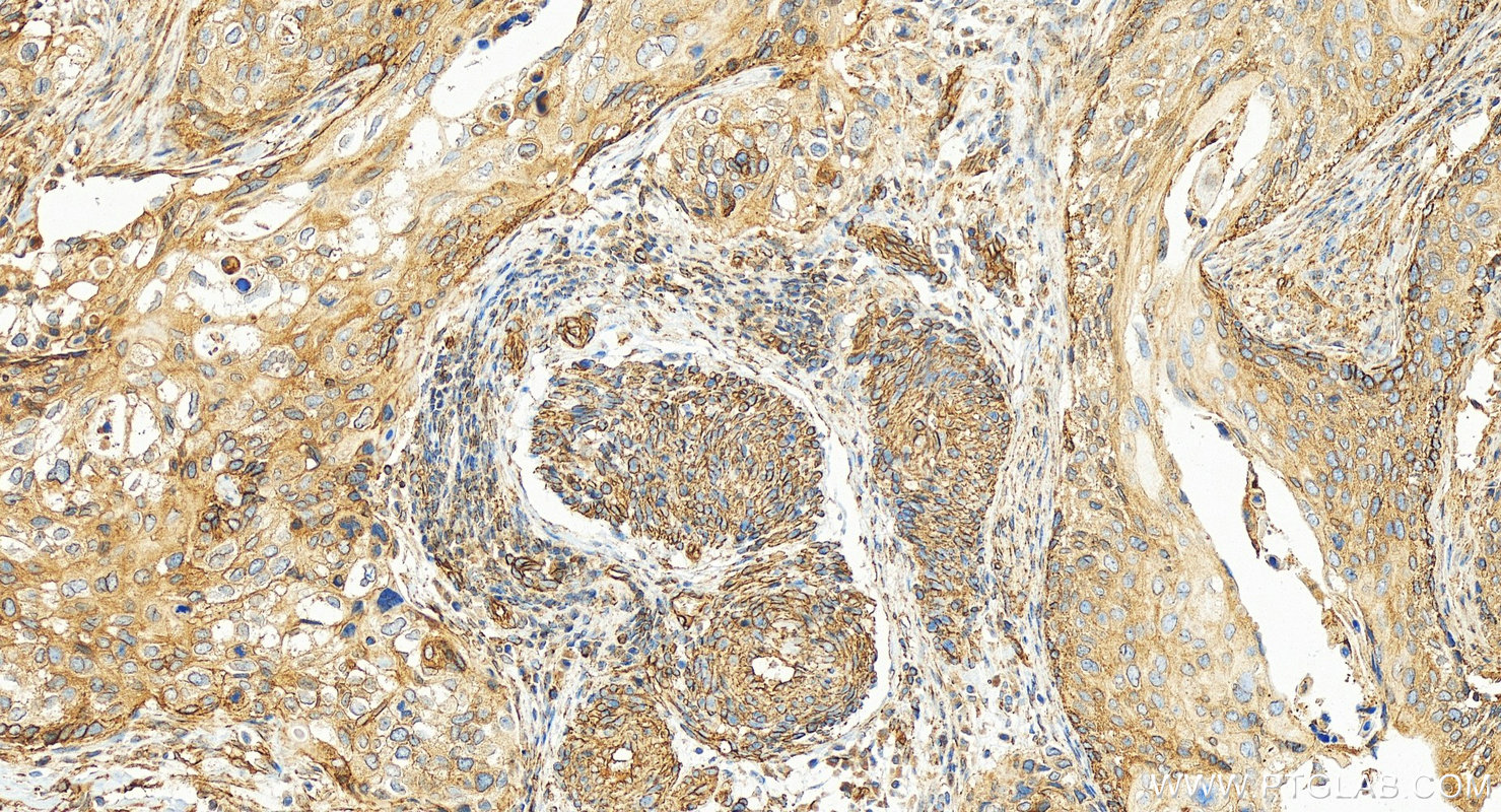 IHC staining of human cervical squamous cancer using 83341-1-RR IHC staining of human cervical squamous cancer using 83341-1-RR