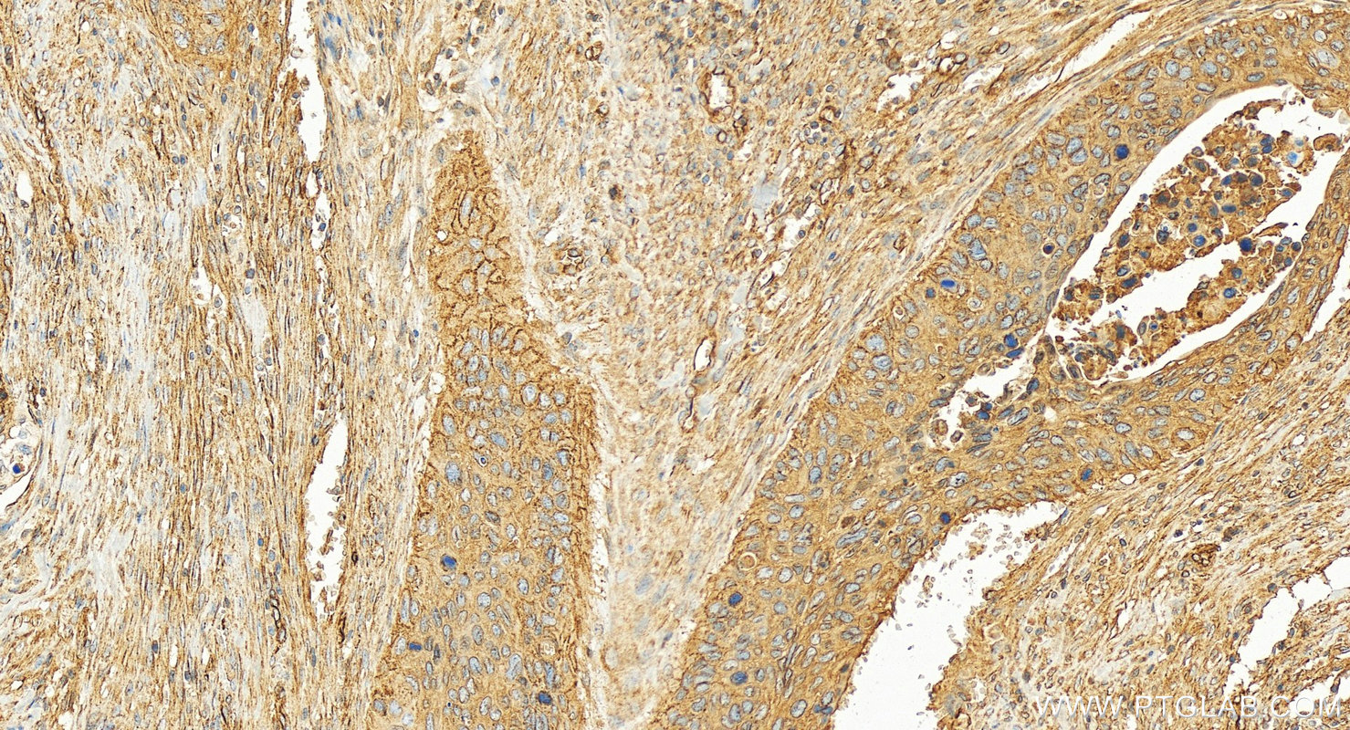 IHC staining of human cervical squamous cancer using 83341-1-RR IHC staining of human cervical squamous cancer using 83341-1-RR