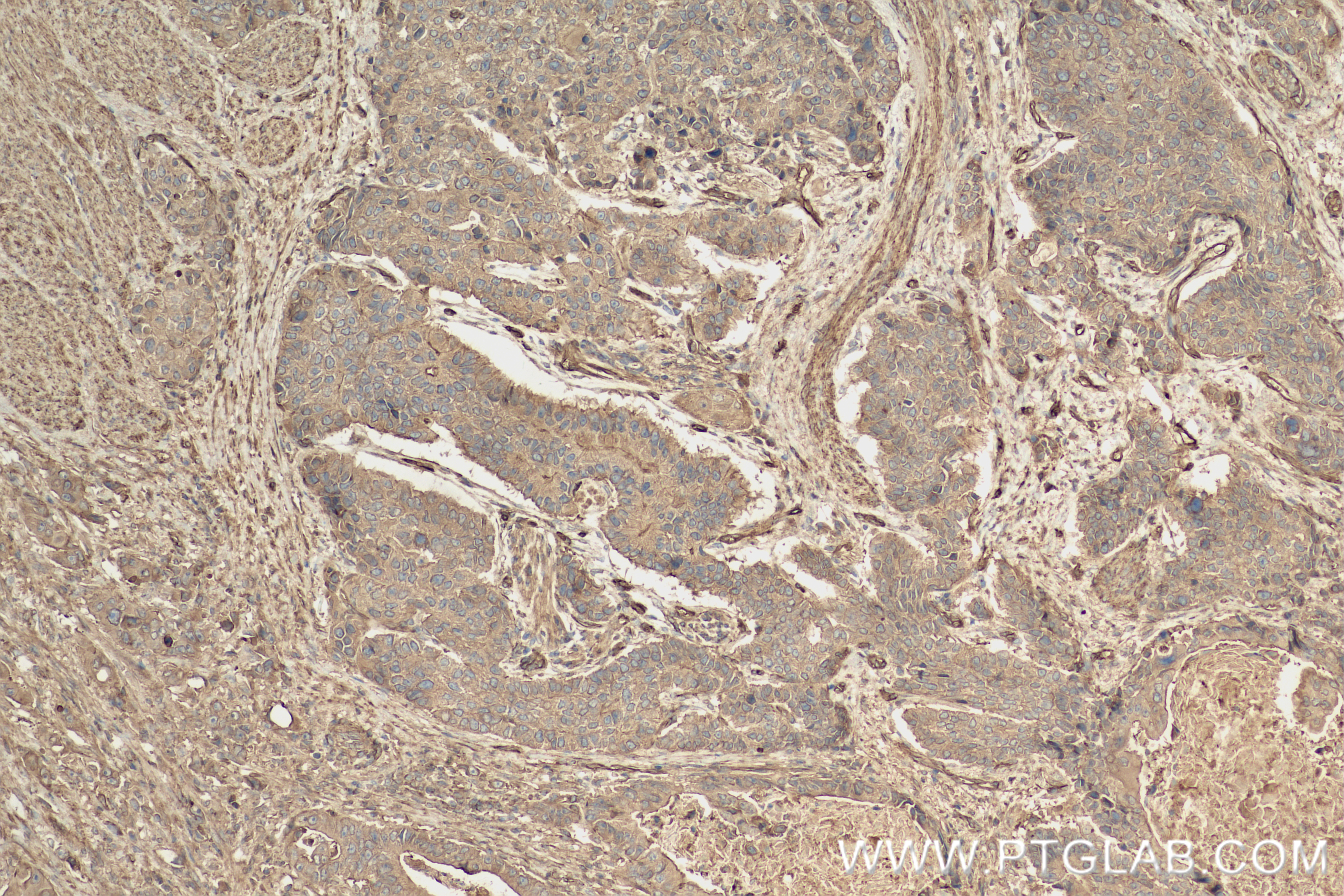 IHC staining of human stomach cancer using 83341-1-RR IHC staining of human stomach cancer using 83341-1-RR