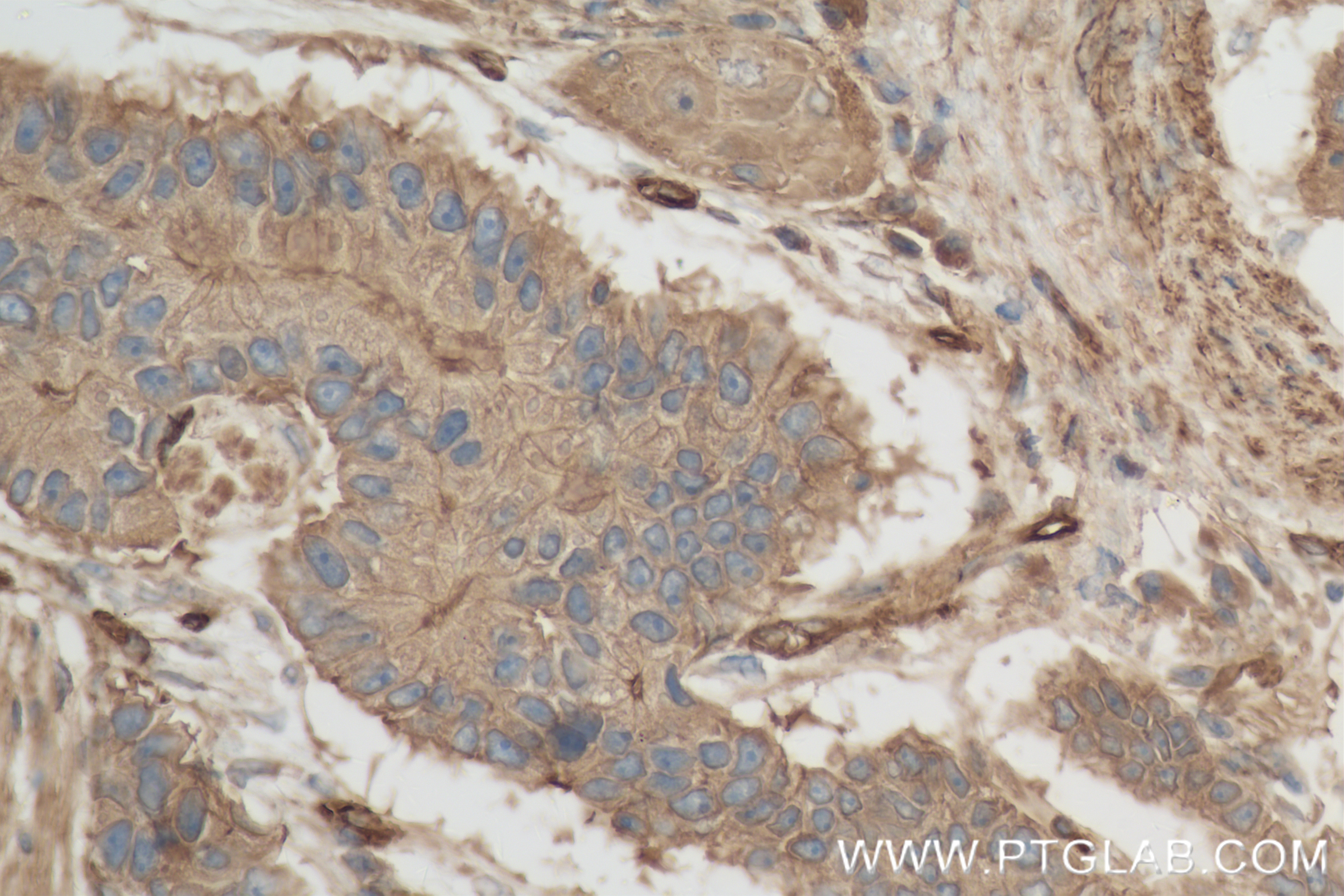 IHC staining of human stomach cancer using 83341-1-RR IHC staining of human stomach cancer using 83341-1-RR