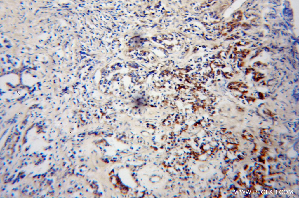 IHC staining of human gliomas using 12970-1-AP
