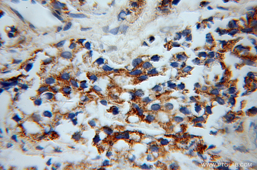 IHC staining of human gliomas using 12970-1-AP