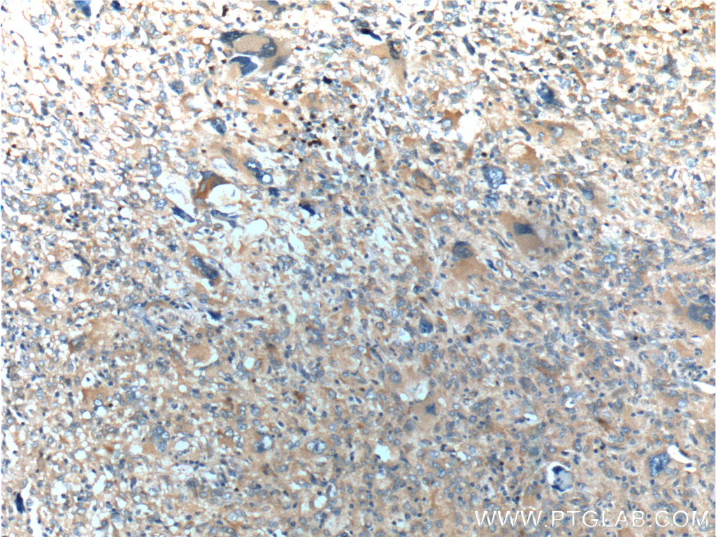 IHC staining of human gliomas using 10837-1-AP