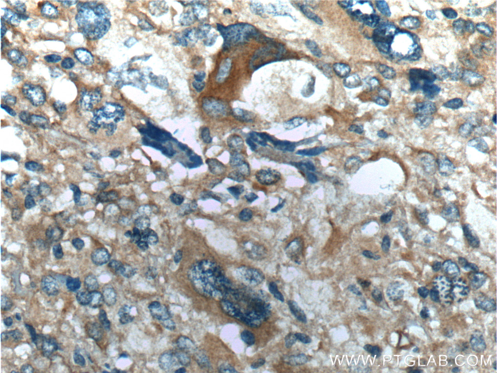 IHC staining of human gliomas using 10837-1-AP