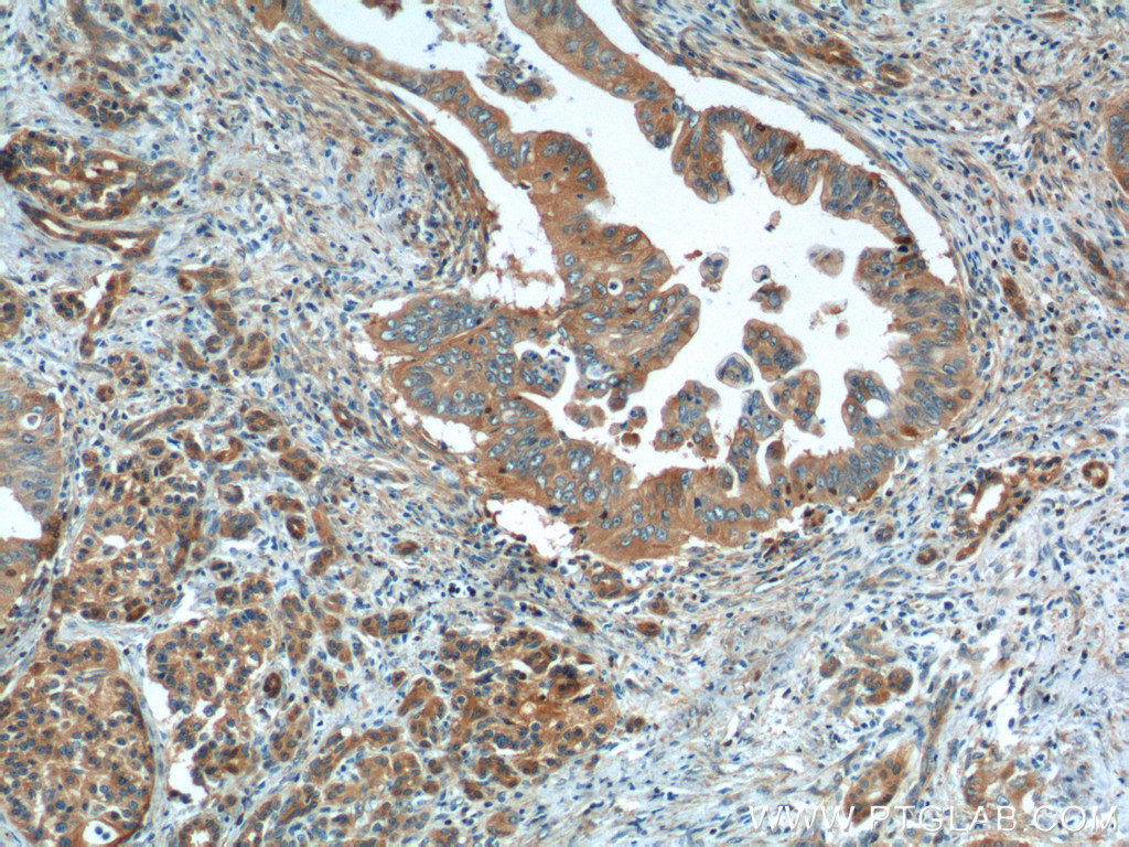 IHC staining of human pancreas cancer using 60293-1-Ig