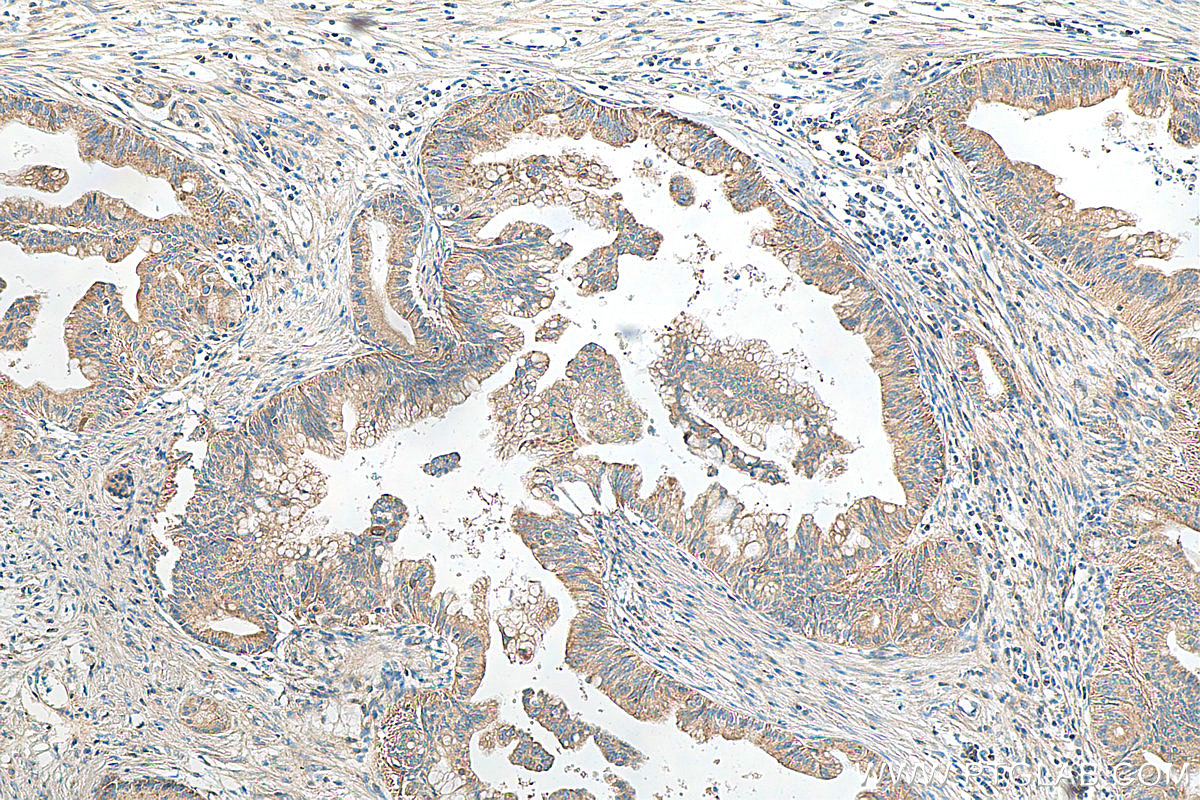 IHC staining of human pancreas cancer using Biotin-60293