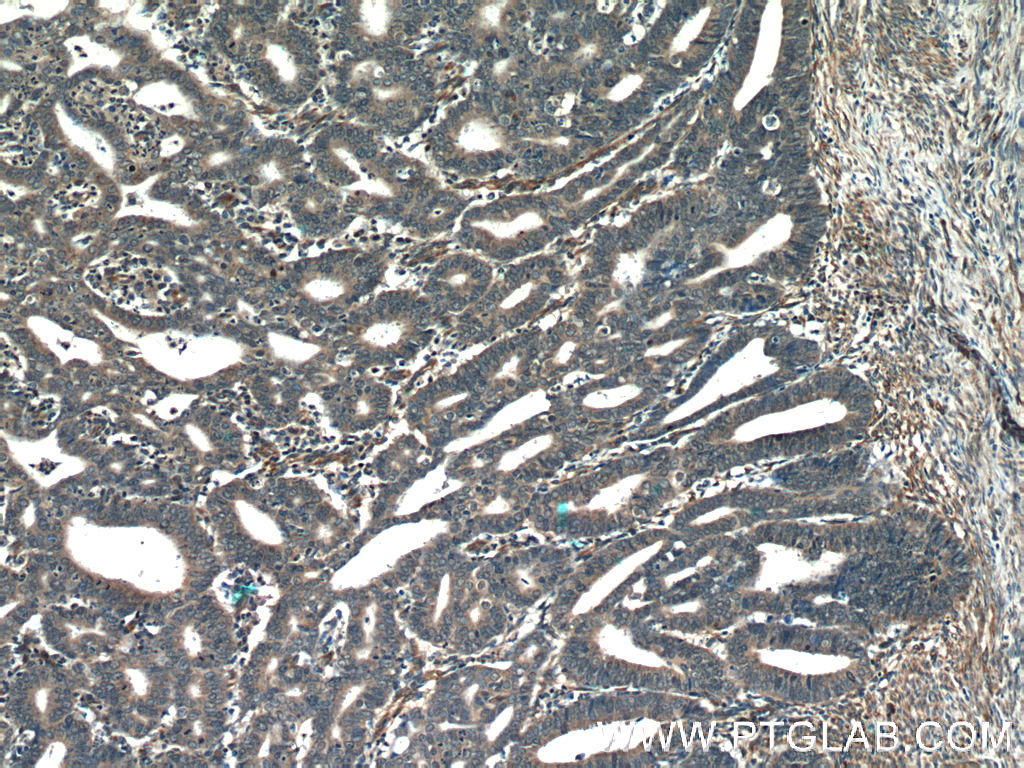 IHC staining of human endometrial cancer using 25766-1-AP