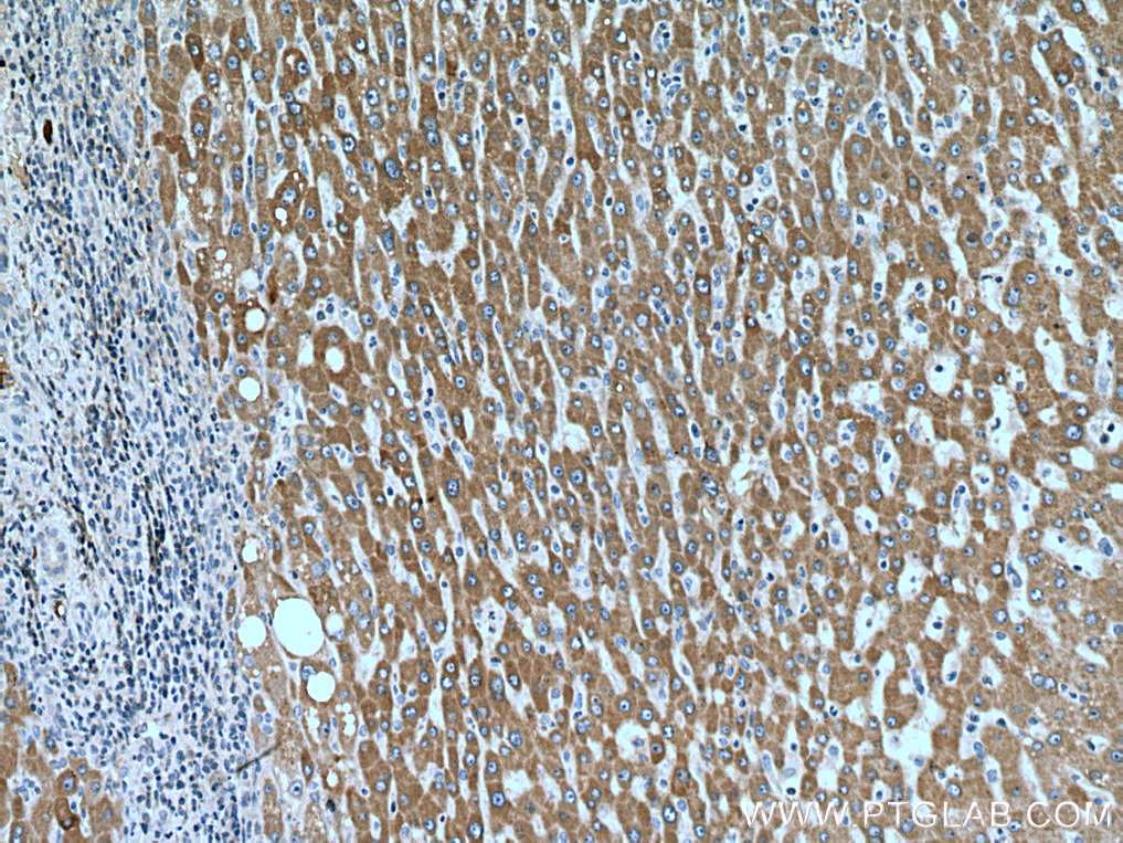IHC staining of human liver cancer using 66217-1-Ig (same clone as 66217-1-PBS)