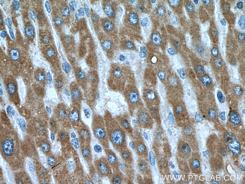 IHC staining of human liver cancer using 66217-1-Ig (same clone as 66217-1-PBS)