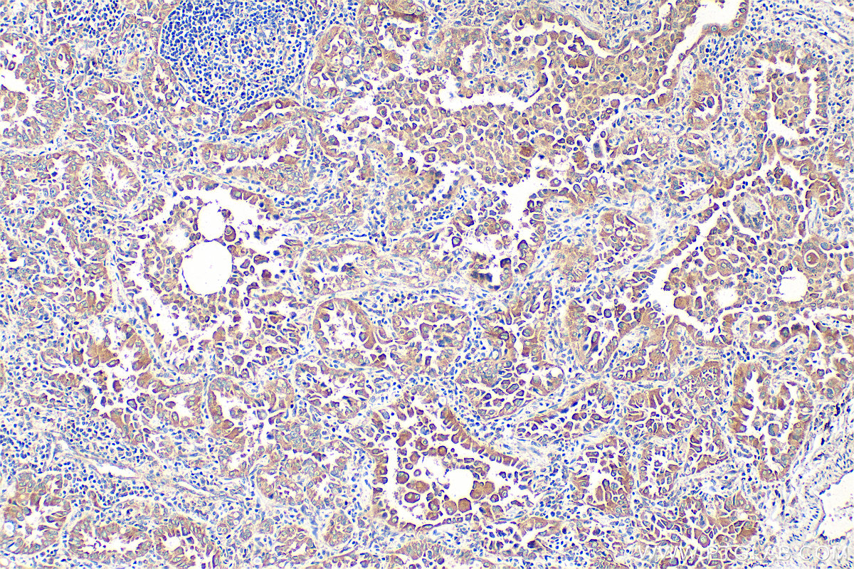 IHC staining of human lung cancer using 10061-1-AP