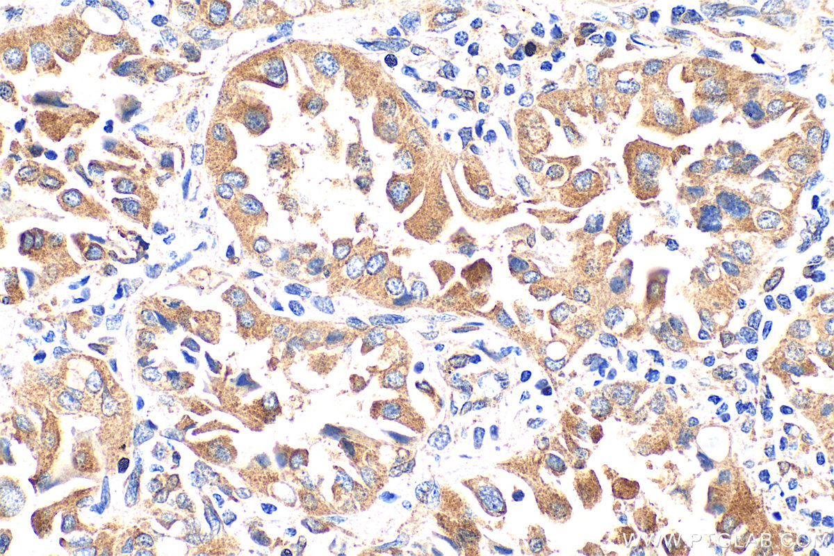 IHC staining of human lung cancer using 10061-1-AP