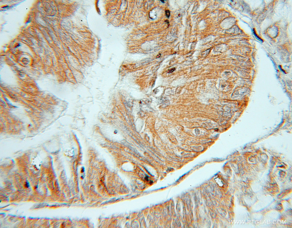 IHC staining of human ovary tumor using 11096-1-AP
