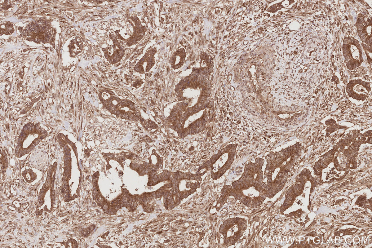 IHC staining of human rectal cancer using 15491-1-AP