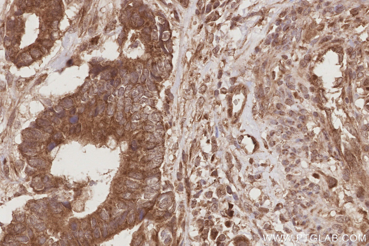 IHC staining of human rectal cancer using 15491-1-AP