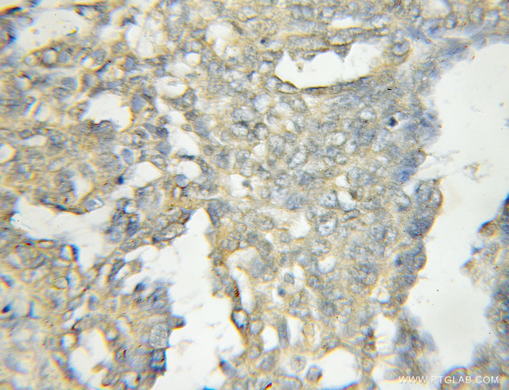 IHC staining of human ovary tumor using 11318-1-AP