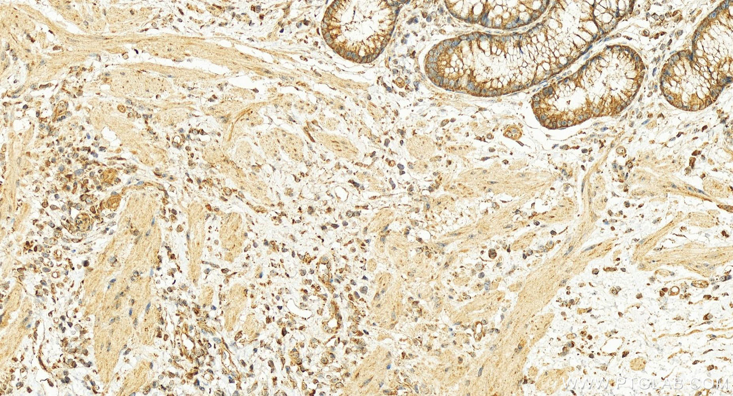 IHC staining of human colon cancer using 12417-1-AP