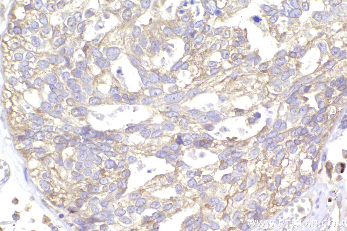 IHC staining of human ovary cancer using 12417-1-AP IHC staining of human ovary cancer using 12417-1-AP