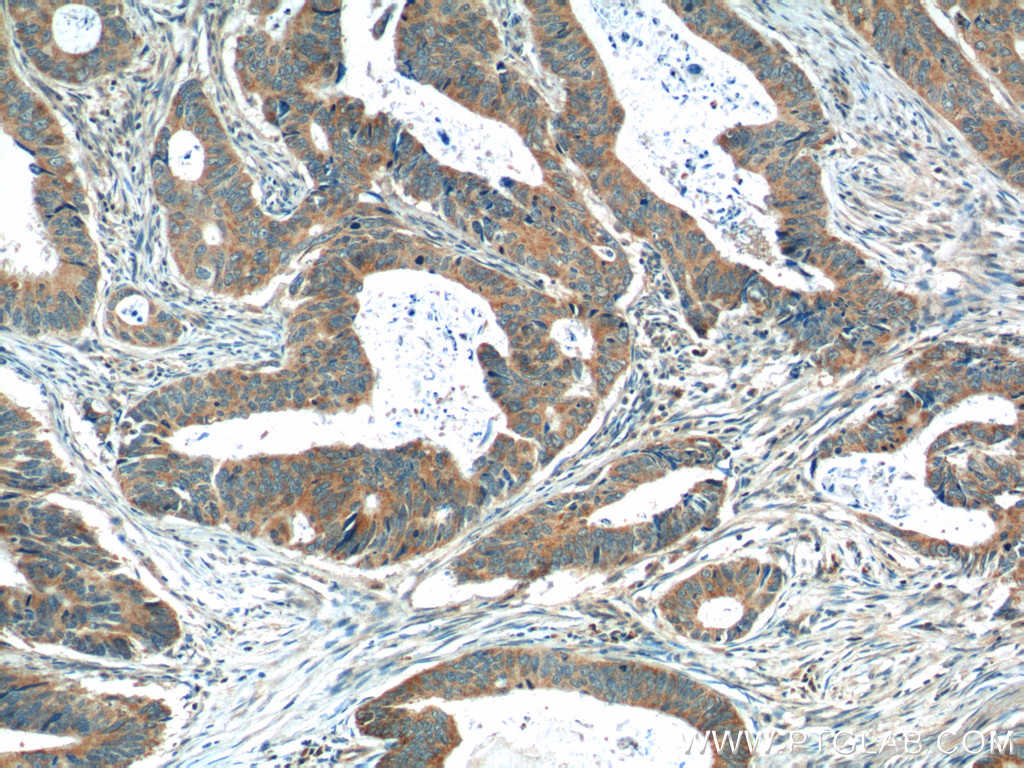 IHC staining of human colon cancer using 12417-1-AP