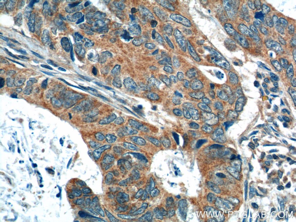 IHC staining of human colon cancer using 12417-1-AP